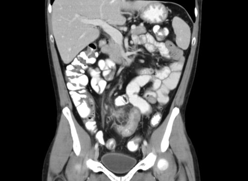CT opacified bowel