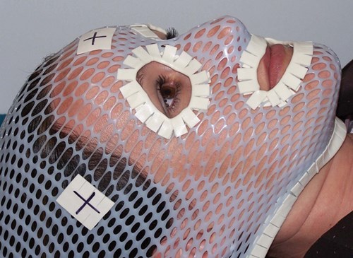 TenderTouch cushioned tape applied to thermoplastic mask