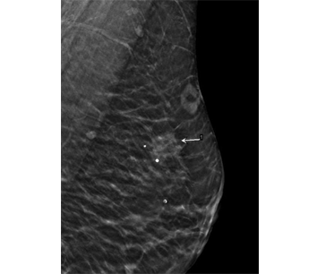 DBT x-ray shows several calcifications in area of reported pain