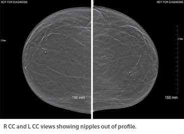 X-ray of R CC and L CC views showing nipples out of profile