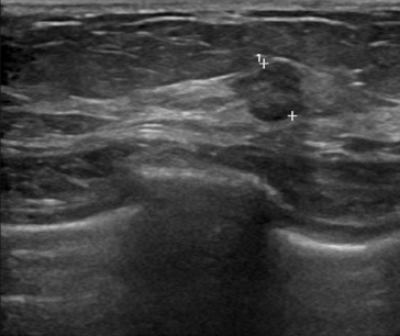 Ultrasound-guided core biopsy demonstrated ductal carcinoma in situ