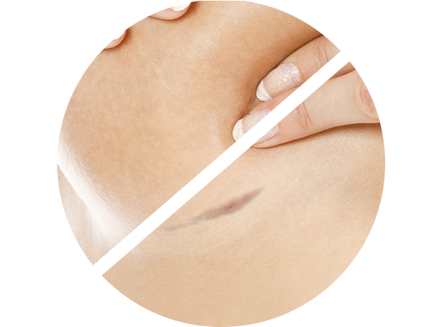 painful skin tear during a mammogram