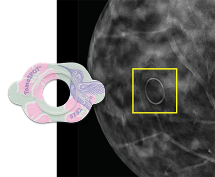 Image of Beekley Medical TomoSPOT mole marker indicating location of skin lesion under digital breast tomosynthesis. Standard screening, right CC view, slice 56.